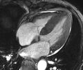 Cardiac amyloidosis (Radiopaedia 39736-42124 D 6).jpg
