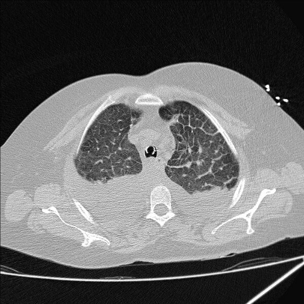 File:Cardiogenic pulmonary edema (Radiopaedia 29213-29609 Axial lung window 17).jpg