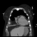 Cardiogenic pulmonary edema (Radiopaedia 29213-29609 Coronal non-contrast 6).jpg