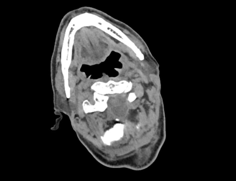 File:Carotid artery pseudoaneurysm (Radiopaedia 84030-99259 Axial non-contrast 7).jpg