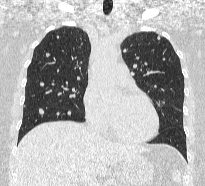 File:Cavitating pulmonary metastases (Radiopaedia 17796-17555 Coronal lung window 8).jpg