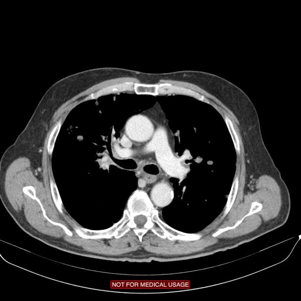 File:Cavitating pulmonary metastases (Radiopaedia 24920-25184 B 10).jpg