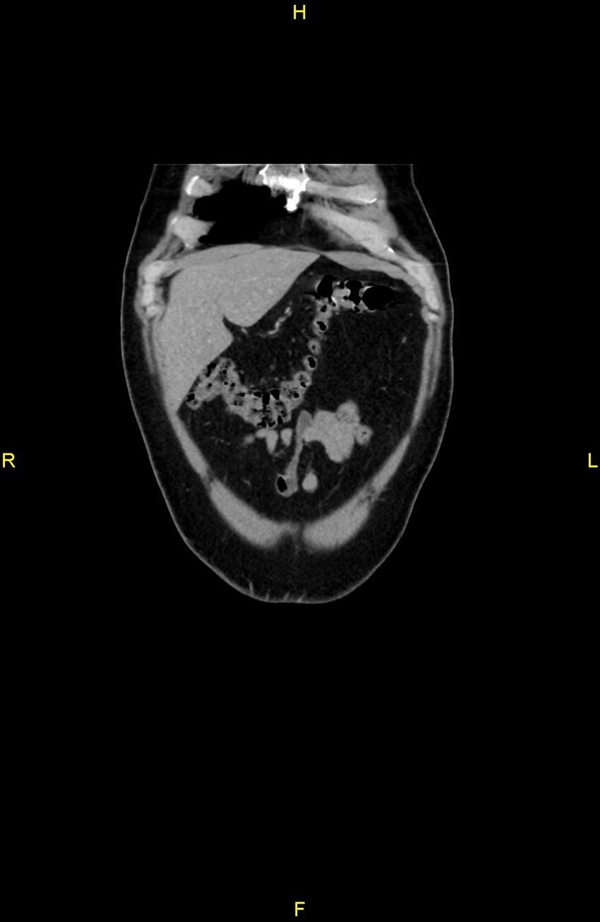 Cecal epiploic appendagitis (Radiopaedia 86047-102164 B 13).jpg