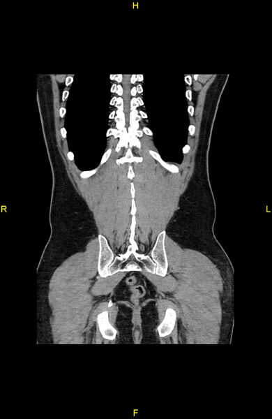 File:Cecal epiploic appendagitis (Radiopaedia 86047-102164 B 74).jpg