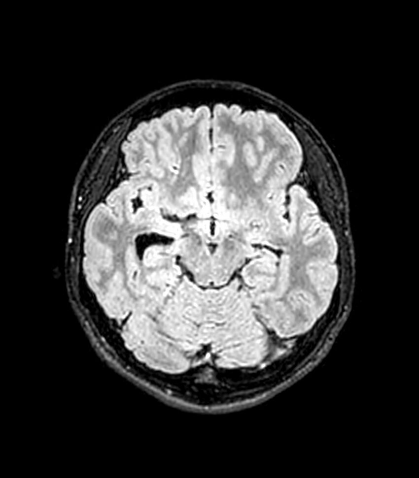 Central neurocytoma (Radiopaedia 79320-92380 Axial FLAIR 191).jpg