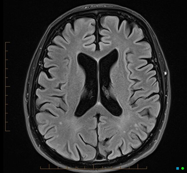 File:Cerebellar gangliocytoma (Radiopaedia 65377-74422 Axial FLAIR 23).jpg