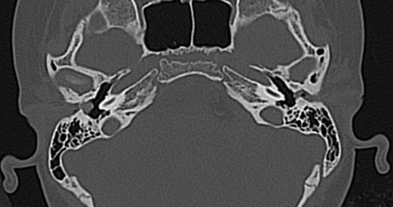 File:Cerebellopontine angle lipoma (Radiopaedia 57303-64242 Axial bone window 20).jpg