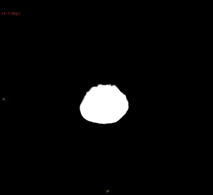 Cerebral amyloid angiopathy-associated lobar intracerebral hemorrhage (Radiopaedia 58378-65518 Coronal non-contrast 11).jpg