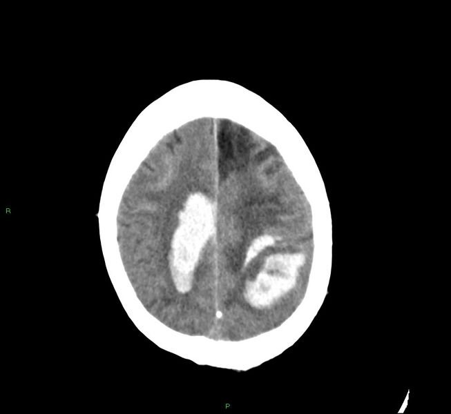 File:Cerebral amyloid angiopathy-associated lobar intracerebral hemorrhage (Radiopaedia 58529-65686 Axial non-contrast 21).jpg