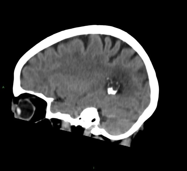 File:Cerebral amyloid angiopathy-associated lobar intracerebral hemorrhage (Radiopaedia 58757-65978 C 18).jpg