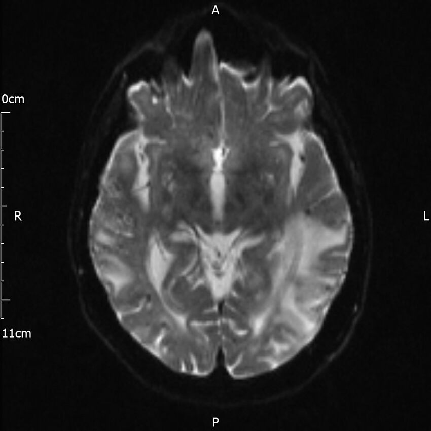 Cerebral amyloid angiopathy related inflammation (Radiopaedia 72772-83415 Axial DWI 11).jpg
