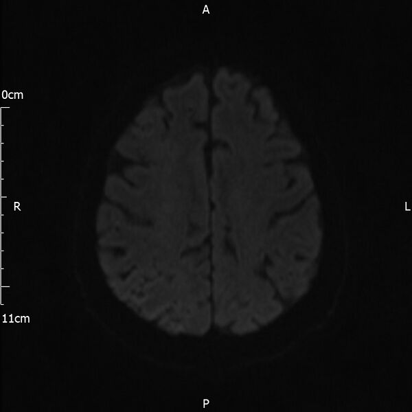 File:Cerebral amyloid angiopathy related inflammation (Radiopaedia 72772-83415 Axial DWI 63).jpg
