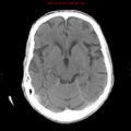 Cerebral and orbital tuberculomas (Radiopaedia 13308-13310 B 13).jpg