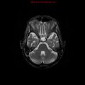 Cerebral and orbital tuberculomas (Radiopaedia 13308-13311 Axial T2 7).jpg