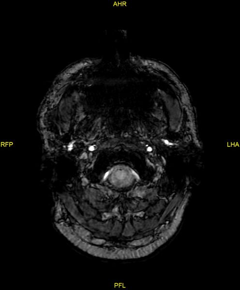 File:Cerebral autosomal dominant arteriopathy with subcortical infarcts and leukoencephalopathy (CADASIL) (Radiopaedia 86108-102054 Axial SWI 6).jpg