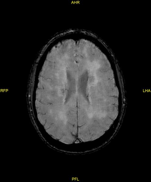 File:Cerebral autosomal dominant arteriopathy with subcortical infarcts and leukoencephalopathy (CADASIL) (Radiopaedia 86108-102054 Axial SWI 70).jpg