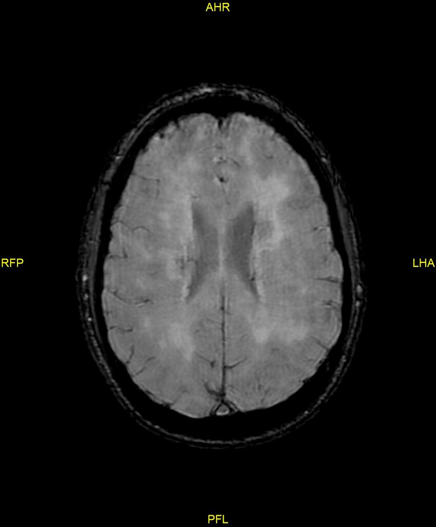 Cerebral autosomal dominant arteriopathy with subcortical infarcts and leukoencephalopathy (CADASIL) (Radiopaedia 86108-102054 Axial SWI 70).jpg