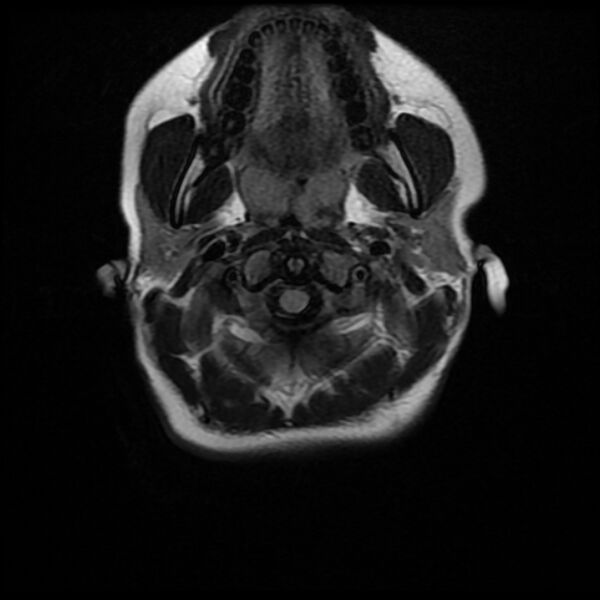 File:Cerebral cavernous malformation (Radiopaedia 44301-47942 Axial FLAIR 1).jpg