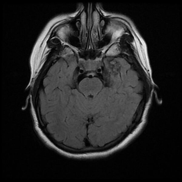 File:Cerebral cavernous malformation (Radiopaedia 44301-47942 Axial FLAIR 7).jpg