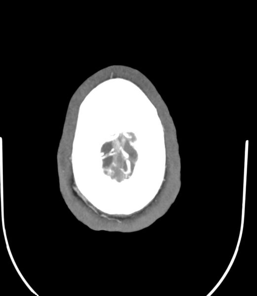 File:Cerebral dural venous sinus thrombosis (Radiopaedia 86514-102576 A 89).jpg
