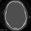 Cerebral hemorrhagic contusion with subdural and subarachnoid hemorrhage (Radiopaedia 10680-11146 Axial bone window 15).jpg