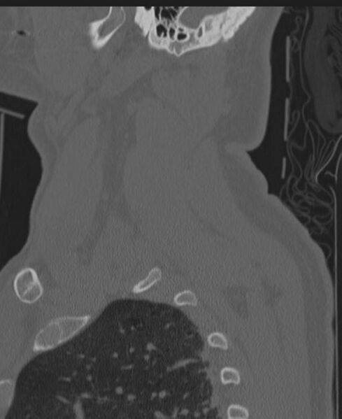 File:Cerebral hemorrhagic contusions and cervical spine fractures (Radiopaedia 32865-33841 Sagittal bone window 86).jpg