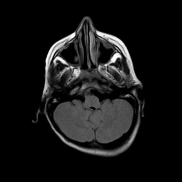 File:Cerebral tuberculoma (Radiopaedia 41152-43932 Axial FLAIR 4).jpg