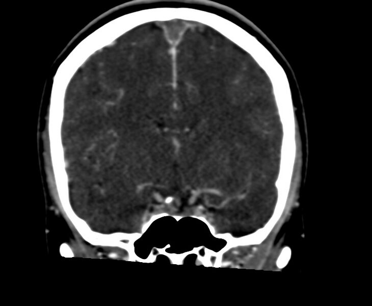 File:Cerebral venous sinus thrombosis (Radiopaedia 59224-66646 Coronal C+ delayed 32).jpg