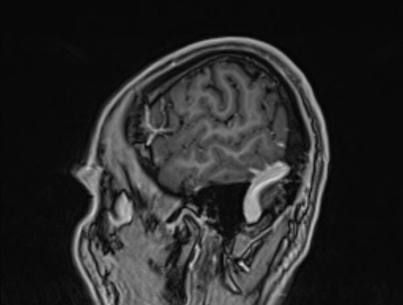 File:Cerebral venous thrombosis (Radiopaedia 71207-81504 Sagittal T1 C+ 5).jpg