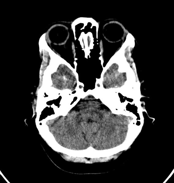 File:Cerebral venous thrombosis - CT only (Radiopaedia 41031-43778 Axial non-contrast 69).jpg