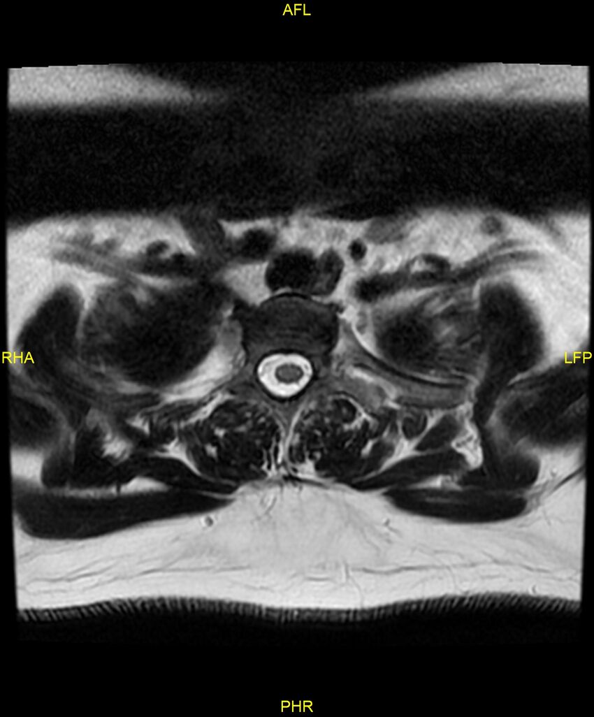 Cervical disc protrusion (Radiopaedia 87147-103415 Axial T2 87).jpg