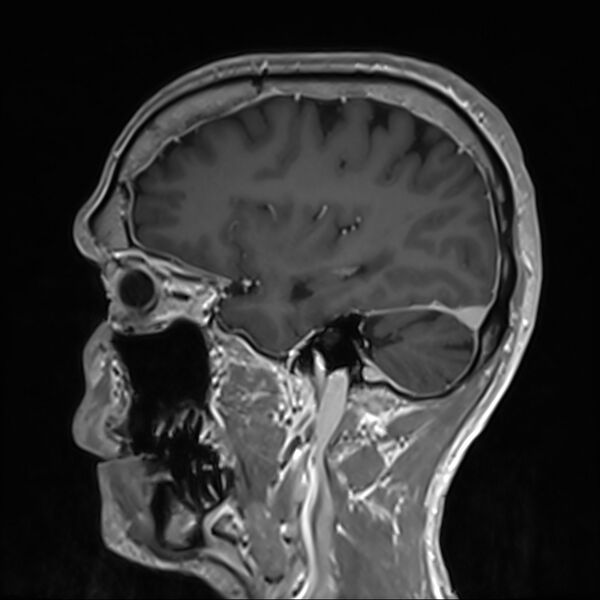 File:Cervical dural CSF leak on MRI and CT treated by blood patch (Radiopaedia 49748-54995 G 25).jpg