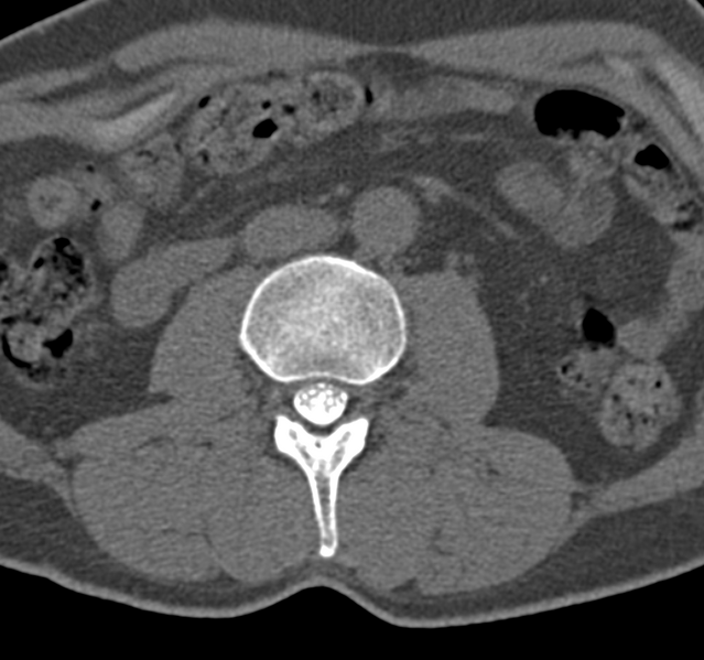 File:Cervical dural CSF leak on MRI and CT treated by blood patch (Radiopaedia 49748-54996 B 98).png
