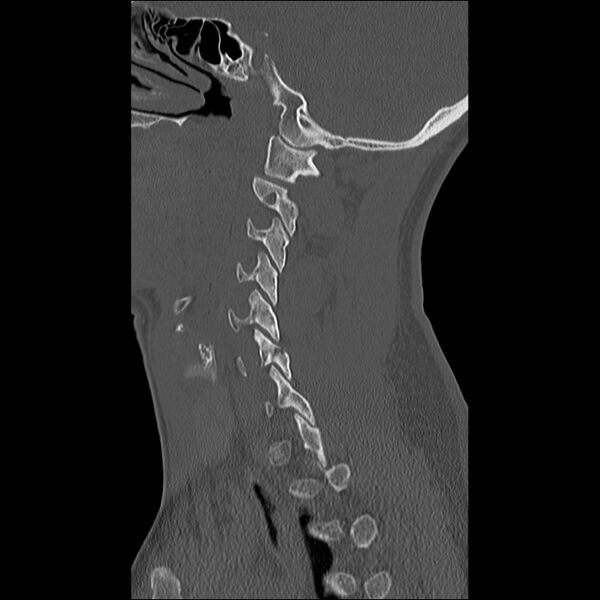 File:Cervical facet fracture and anterior discoligamentous injury (Radiopaedia 32139-33083 Sagittal bone window 28).jpg