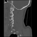 Cervical flexion teardrop fracture with cord hemorrhage (Radiopaedia 32497-33454 Sagittal bone window 10).jpg