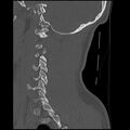 Cervical flexion teardrop fracture with cord hemorrhage (Radiopaedia 32497-33454 Sagittal bone window 35).jpg