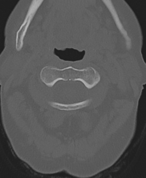 File:Cervical spine ACDF loosening (Radiopaedia 48998-54071 Axial bone window 18).png