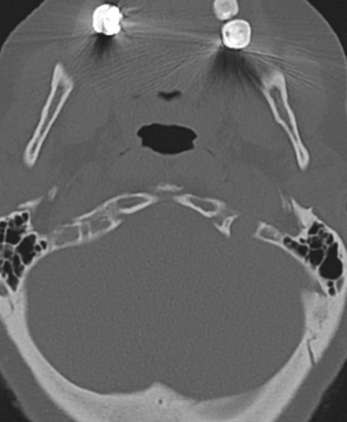 File:Cervical spine ACDF loosening (Radiopaedia 48998-54071 Axial bone window 9).png