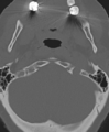Cervical spine ACDF loosening (Radiopaedia 48998-54071 Axial bone window 9).png