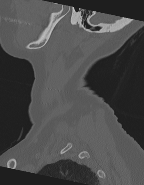 File:Cervical spine ACDF loosening (Radiopaedia 48998-54071 Sagittal bone window 12).png