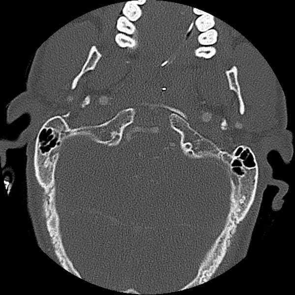 File:Cervical spine fractures with vertebral artery dissection (Radiopaedia 32135-33078 Axial bone window 75).jpg