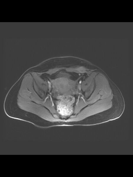 File:Cesarean section scar endometrioma (Radiopaedia 56569-63297 Axial T1 C+ fat sat 21).jpg