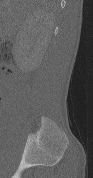 File:Chance fracture (Radiopaedia 40360-42912 Sagittal bone window 88).png