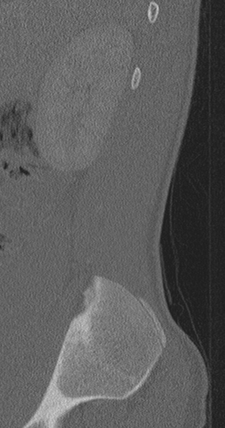 File:Chance fracture (Radiopaedia 40360-42912 Sagittal bone window 89).png