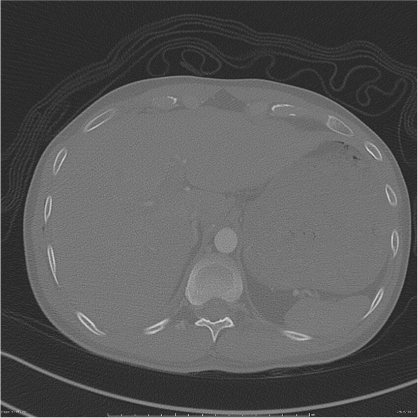 Chest and abdomen multi-trauma (Radiopaedia 26294-26425 bone window 97).jpg