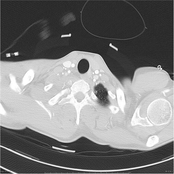 File:Chest and abdomen multi-trauma (Radiopaedia 26294-26425 lung window 12).jpg
