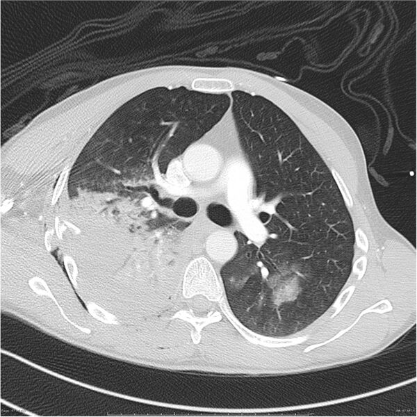 File:Chest and abdomen multi-trauma (Radiopaedia 26294-26425 lung window 47).jpg
