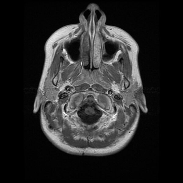 File:Chiasmatic-hypothalamic juvenile pilocytic astrocytoma (Radiopaedia 78533-91236 Axial T1 C+ 4).jpg