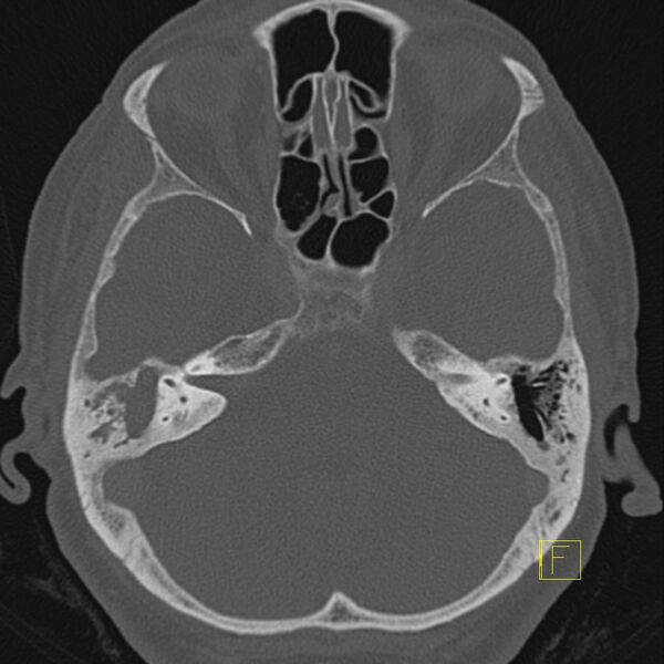 File:Cholesteatomatous chronic otitis (Radiopaedia 14993-14911 Axial bone window 6).JPEG