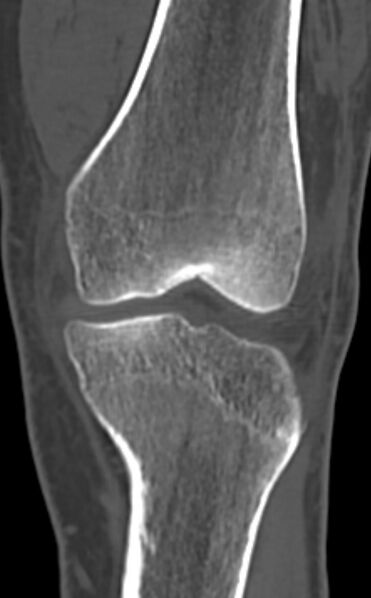 File:Chondrocalcinosis (Radiopaedia 82862-97173 Coronal bone window 31).jpg